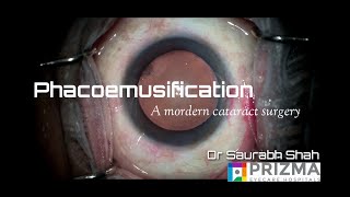 Phacoemulsification Procedure Explained  Ultramodern Cataract Surgery [upl. by Theodor]