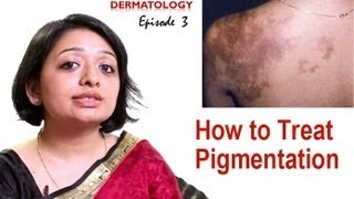 How to Treat Skin Pigmentation Episode 3 [upl. by Nosnirb]