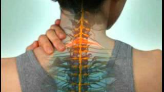 Cervical Radiculopathy  DePuy Videos [upl. by Cortney]