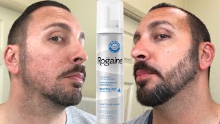 How to grow a REAL Beard  Minoxidil 4 Month Beard Journey [upl. by Pavlish]