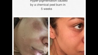 Treating Hyperpigmentation Caused By A Chemical Peel [upl. by Naujtna169]