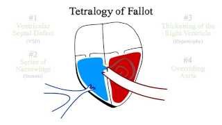 Tetralogy of Fallot [upl. by Alliuqal]