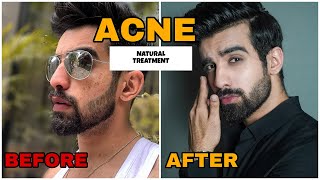 HOW TO REMOVE ACNE OVERNIGHT  NATURAL  PIMPLES  FAST ACNE TREATMENT MARKS HOME REMEDIES HINDI [upl. by Westfahl]