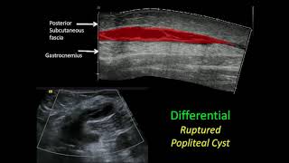 Treatment of Atherosclerosis Therapy Goals amp Lifestyle Measures – Vascular Medicine  Lecturio [upl. by Meghan]