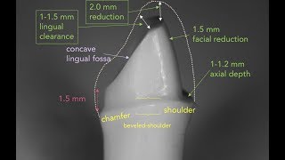 Anterior PFM Preparation  Dr Richard Stevenson [upl. by Bertrand]