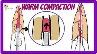 ENDODONTICS  OBTURATION TECHNIQUES  Warm Vertical Compaction technique [upl. by Clarinda]