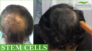 STEM CELL  PRP Therapy for Hair Loss with THREE MONTH UPDATE [upl. by Matthaus]