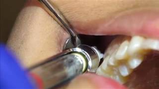 Posterior Superior Alveolar PSA Injection Demonstration and Overview 4K [upl. by Torhert512]