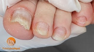 Toenail fungus cleaning [upl. by Sibilla298]