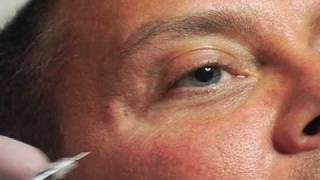 Botox Before and After Crows Feet [upl. by Columba]