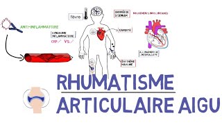 Rhumatisme articulaire aigu RAAde A à Z [upl. by Elvah]