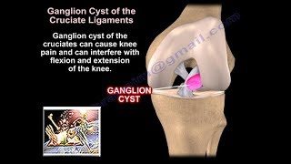 Large popliteal cyst of knee [upl. by Wilona]