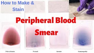 Peripheral Blood Smear Peripheral Smear Examination  Leishmans Staining Procedure [upl. by Eaned]