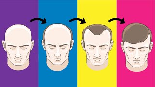 Top 5 Hair Loss Solutions That Actually Work [upl. by Skcirdnek204]