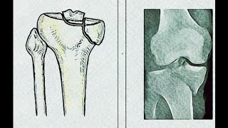 Posteromedial Approach to the Proximal Tibia [upl. by Vatsug]