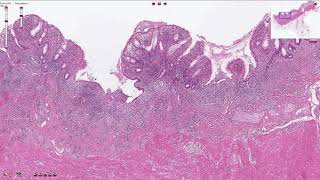 Celiac Disease  Clinical Presentation [upl. by Airdnalahs]