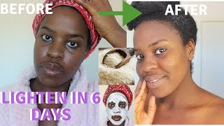 How I How i BRIGHTENED MY SKIN IN 6 DAYS REALISTIC and Natural way to reduce hyperpigmentation [upl. by Thynne205]