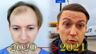 FUE Hair Transplant Growth Timeline  Before amp After [upl. by Mert]