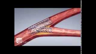 Coronary Artery Angioplasty  Radial Access [upl. by Llemmart]