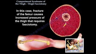 Iliopsoas Pelvic Compartment Syndrome Everything You Need To Know Dr Nabil Ebraheim [upl. by Aivull822]