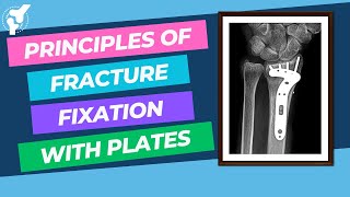 Principles of Fracture Internal Fixation With Plates and Screws  Material Properties [upl. by Parish]