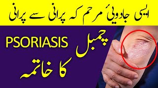 CHAMBAL Ka Ilaj  چمبل  Psoriasis  Signs amp Treatment in URDUHINDI  Hakeem Malik Ahmad Farooq [upl. by Trenton670]