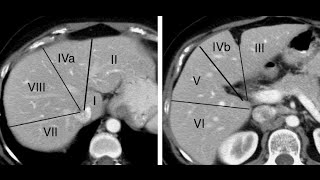 TC do abdome Segmentação hepática [upl. by Loram219]