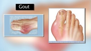 Gout and Turmeric [upl. by Brodie]