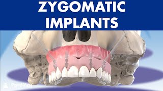 ZYGOMATIC implants  How to place dental implants without bone © [upl. by Busch630]