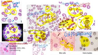 hematology in 10 min Peripheral blood smear examination under microscope [upl. by Retxed]