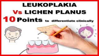 leukoplakia vs lichen planus  10 points to differentiate clinically [upl. by Koeppel]