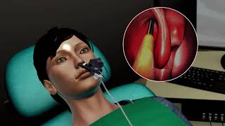 Balloon Sinus Surgery Animation [upl. by Ahsitra]