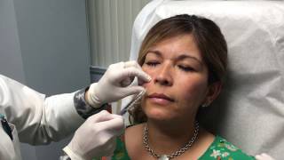 Juvederm Vollure Injection Treatment [upl. by Llewoh545]