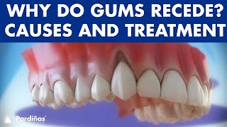 Gum recession  Treatment of gingival retraction © [upl. by Eimmis]