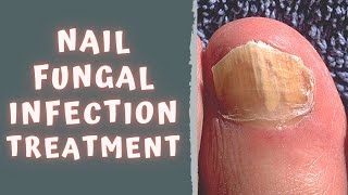 HOW TO TREAT FUNGAL NAIL INFECTION  TINEA UNGUIUM  ONYCHOMYCOSIS [upl. by Ardied]