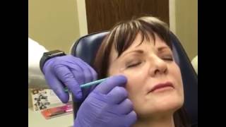 Wrinkle Treatment Dysport Filler for Crows Feet Wrinkles Near Eyes [upl. by Garner]