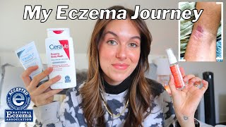 HOW I BEAT MY ECZEMA FOR GOOD  My journey product recommendations  body care tips  Rudi Berry [upl. by Aile]