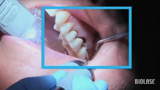 Remoción de caries con lasers Biolase  Streamhealth Dental [upl. by Jillane]