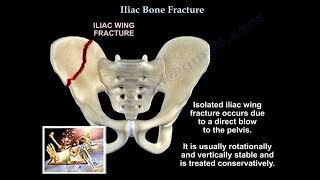 Iliac Bone Fracture  Everything You Need To Know  Dr Nabil Ebraheim [upl. by Sessler]