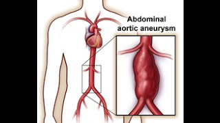 Abdominal Aortic Aneurysm AAA [upl. by Gayel]