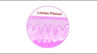 Lichen planus Histopathological features  Lets draw [upl. by Arata]