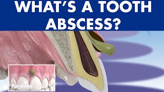 TOOTH ABSCESS dental infection  PHLEGMON symptoms and treatment © [upl. by Norga]