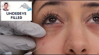 Oculoplastics Aesthetic Eyelid Surgery Botox and Fillers [upl. by Anerbas]