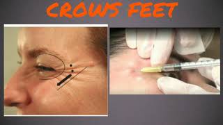 Chapter 4Botox injection for crows feet [upl. by Ana]