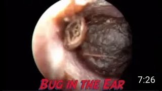 Insect inside the ear [upl. by Aihsein]