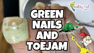 GREEN NAILS AND TOEJAM CUTTING LONG THICK GREEN TOENAILS [upl. by Orlantha]