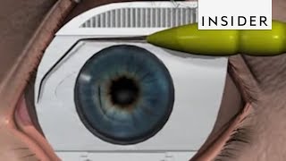 How LASIK Eye Surgery Is Performed [upl. by Scharff]