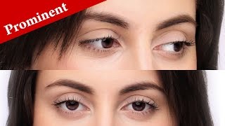 How to immediately know if your eyes are PROMINENT or PROTRUDING [upl. by Etteniuqna878]