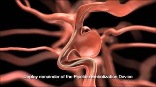 Understanding Abdominal Aortic Aneurysms  Access Health [upl. by Aliuqaj]