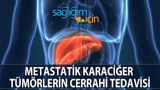 Metastatik Karaciğer Tümörlerin Cerrahi Tedavisi [upl. by Revell]